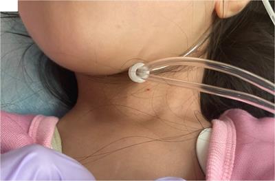 Case report: Thyroid storm in a three-year-old girl presenting with febrile status epilepticus and hypoglycemia